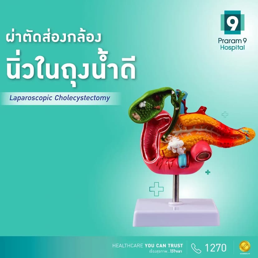 โปรแกรมผ่าตัดนิ่วในถุงน้ำดีโดยการส่องกล้อง (ดมยาสลบ, นอน 2 คืน)