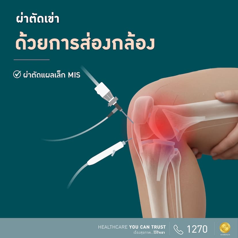 โปรแกรมผ่าตัดเข่าด้วยการส่องกล้อง 